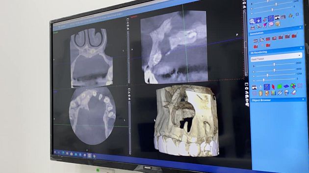 拖2年才就醫！男歌手「牙齦破大洞」　牙醫急警告：可能會毀容