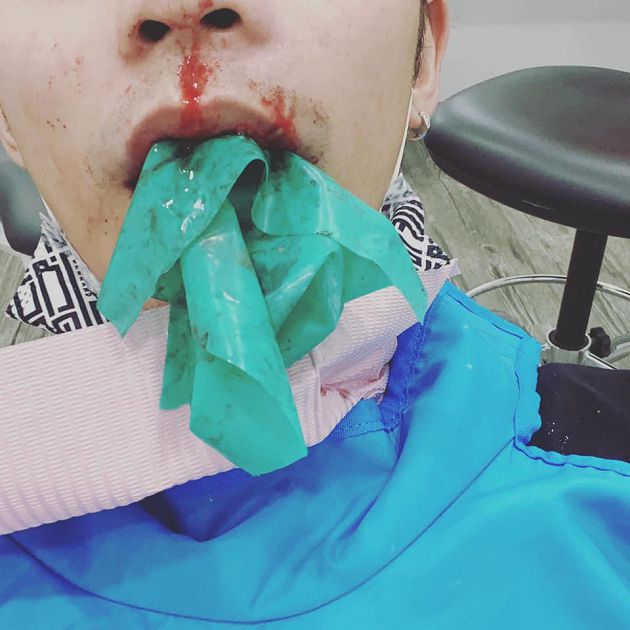 拖2年才就醫！男歌手「牙齦破大洞」　牙醫急警告：可能會毀容