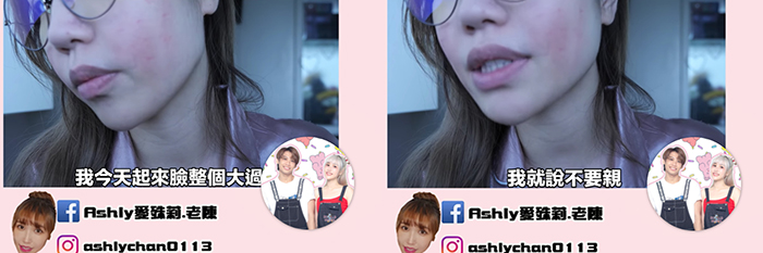 連腳底板也不放過！ 遭尼克狂親一整天  Ashly起床驚見臉上起「大片紅疹」崩潰：超髒的