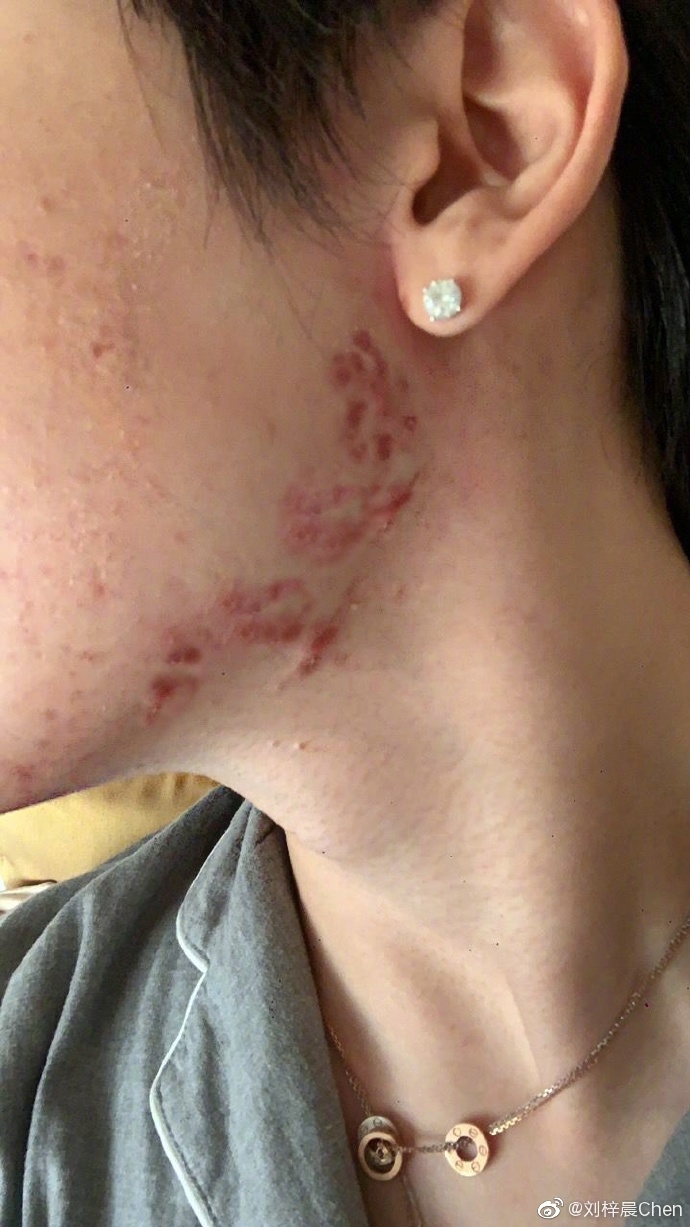 全臉毀容!蛇精男爆「滿臉爛痘」驚悚近照曝光 網嚇歪:得病了?