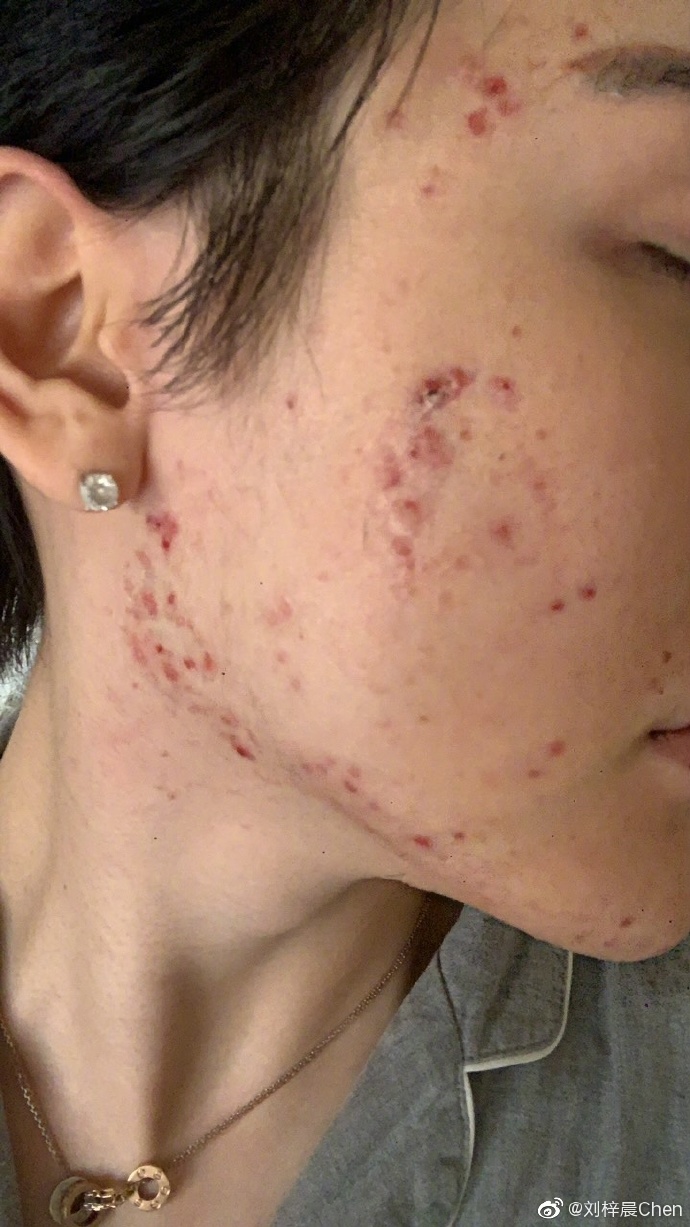 全臉毀容!蛇精男爆「滿臉爛痘」驚悚近照曝光 網嚇歪:得病了?