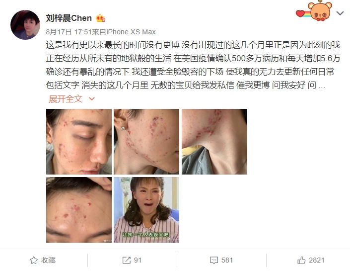 全臉毀容!蛇精男爆「滿臉爛痘」驚悚近照曝光 網嚇歪:得病了?