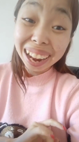 「快手嘟嘟姐」近況曝光！2年後「暴牙凸嘴」消失　網全嚇歪：美炸！